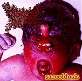 Viscera Infest - Sarcoidosis